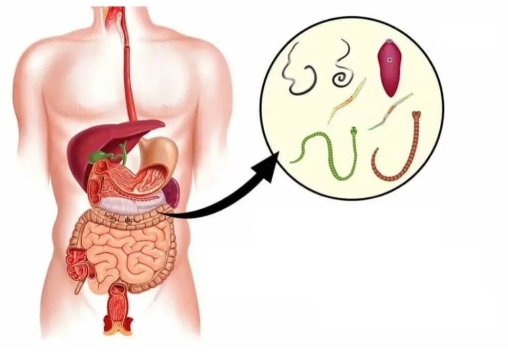 Parasites dans divers organes