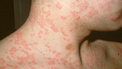 Quels parasites du corps peuvent provoquer des allergies